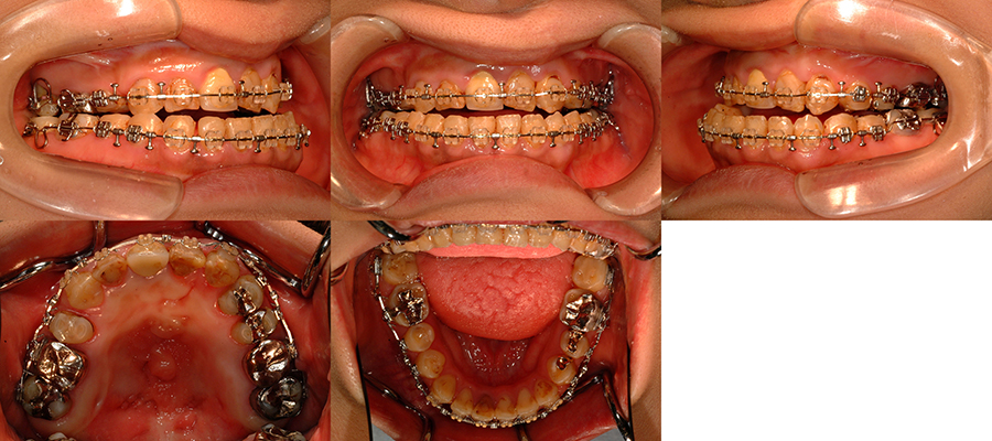 口唇口蓋裂の治療例　左側唇顎口蓋裂に起因する顔面非対称を呈する骨格性下顎前突　顎矯正手術直前　口腔内